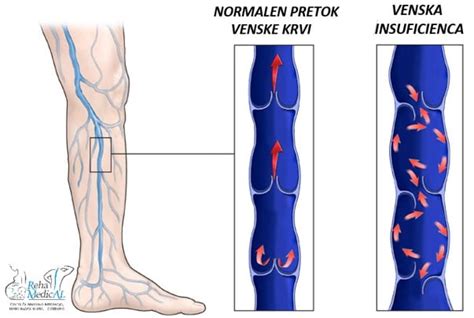 Diagram, ki prikazuje vensko popuščanje in njegovo vplivanje na pretok krvi v nogah