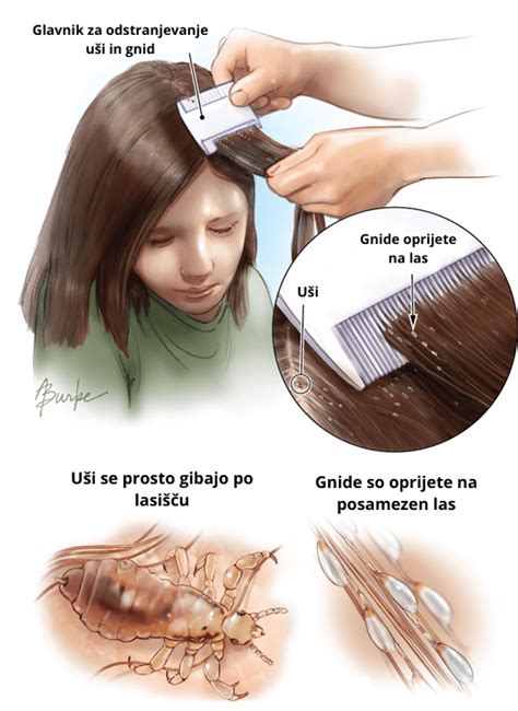 Ilustracija naglavne uši in gnid na lasu