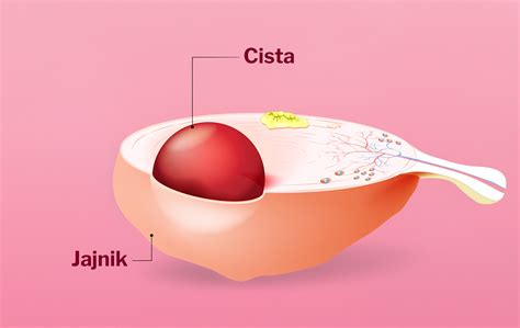 Diagram prikazuje ultrazvočni prikaz ciste na jajčniku