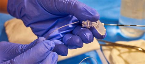 Ilustracija anesteziologa, ki vstavi epiduralni kateter v hrbtenico