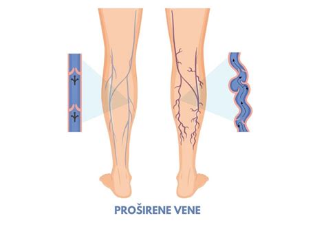 simptomi zgornje vene kave