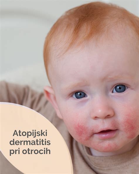 Ilustracija različnih vrst dermatitisa pri dojenčkih