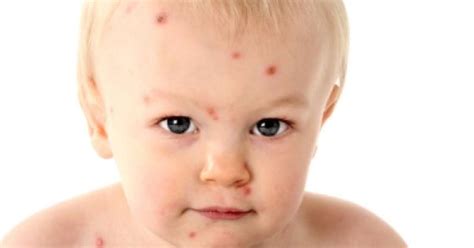 Fotografija dojenčka z rdečimi lički in izpuščaji