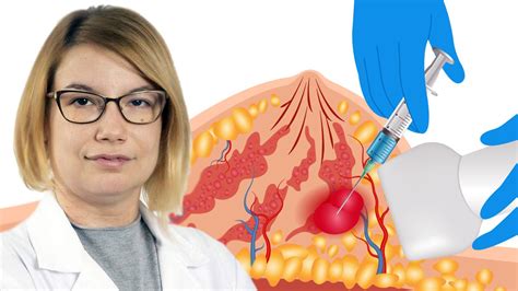 Ilustracija vnetja dojke z rdečico in oteklino