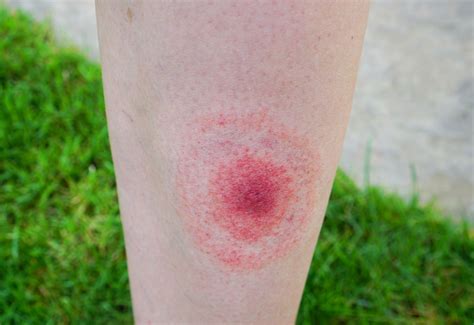 Rdeč kolobar na koži kot znak borelioze