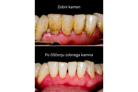 čiščenje zobnega kamna pri psu