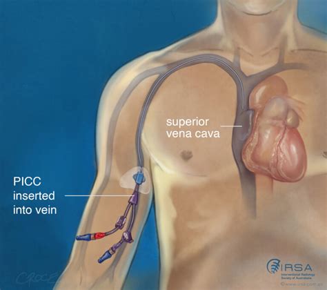 Ilustracija PICC katetra vstavljenega v veno
