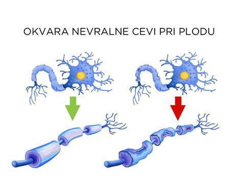 Diagram, ki ponazarja vpliv folne kisline na razvoj nevralne cevi ploda