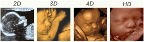 Ultrazvočni 3D/4D prikaz ploda
