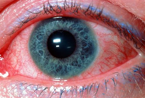 Rdeče, vneta očesa pri dojenčku