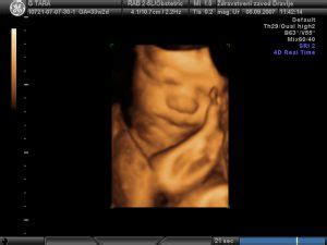 Ultrazvočni aparat z zaslonom, ki prikazuje sliko ploda