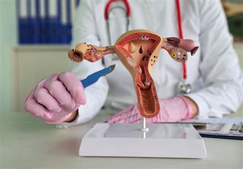 Diagram, ki prikazuje vraščanje endometrijskega tkiva v stene maternice pri adenomiozi
