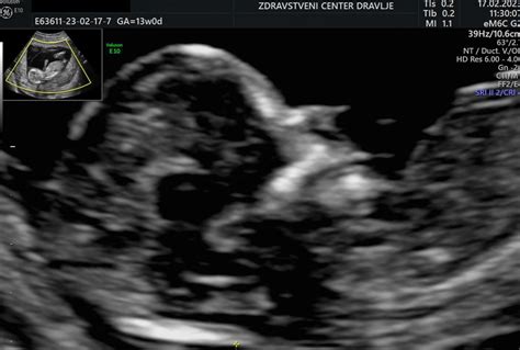 Ultrazvočna slika ploda z označenim območjem nuhalne svetline