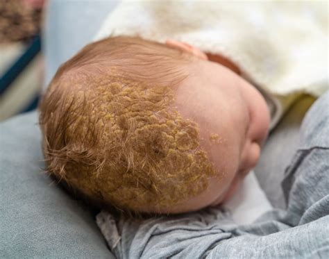 Dojenčkovo lasišče z nežnimi temenicami