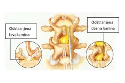 Diagram hrbtenice z označenim mestom epiduralne analgezije