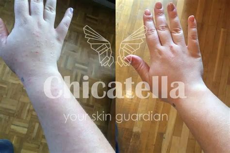 Shema, ki prikazuje tipične predele atopičnega dermatitisa pri dojenčkih.