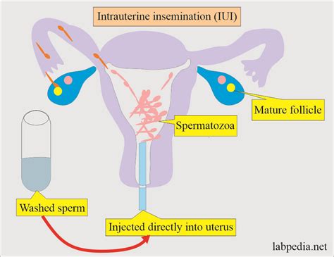 Diagram procesa intrauterine inseminacije (IUI)