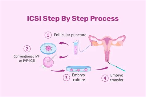 Diagram procesa oploditve in vitro (IVF) in ICSI