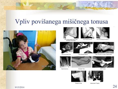 diagram mišičnega tonusa