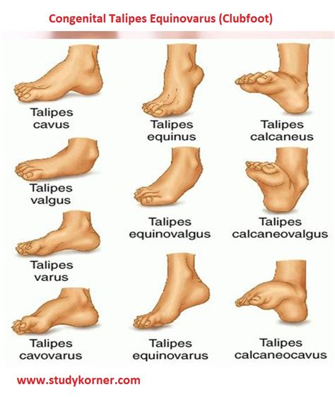 Diagram prikazuje klasično stopalo (talipes equinovarus) v primerjavi z normalnim stopalom