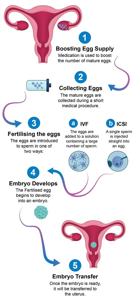 Diagram postopka IVF.