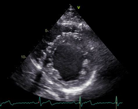 Ultrazvočni posnetek predležeče posteljice