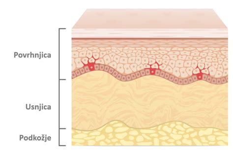 Ilustracija suhe, razpokane kože