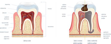 Diagram zobne gnilobe, ki se širi v pulpo