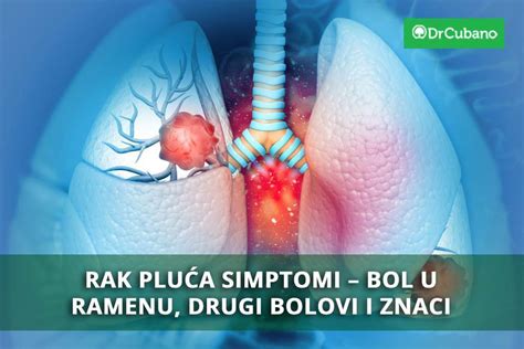 Ilustracija moške dojke s poudarjenimi deli, kjer se lahko pojavijo simptomi raka