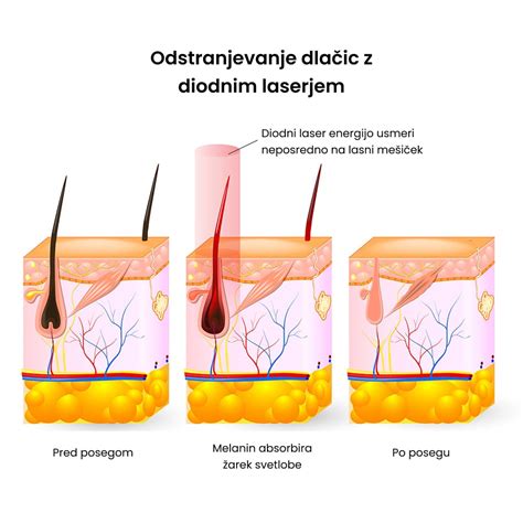 Diagram, ki prikazuje delovanje laserja na lasni mešiček