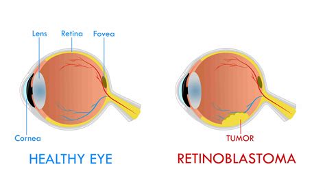 Diagram različnih metod zdravljenja retinoblastoma