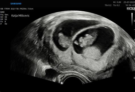 Ultrazvočni pregled ploda med nosečnostjo