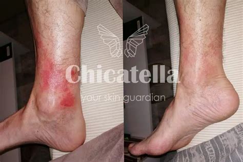 Grafični prikaz pogostih alergenov, ki lahko vplivajo na atopijski dermatitis.