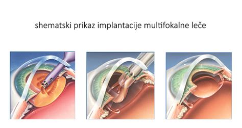 Diagram, ki prikazuje odstranitev motne leče in vstavitev umetne intraokularne leče med operacijo sive mrene.