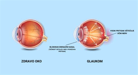Primerjava pogledov skozi zdravo oko, oko s sivo mreno in oko s keratokonusom.