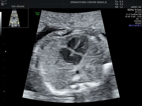 pregled ultrazvok ploda v 35. tednu nosečnosti