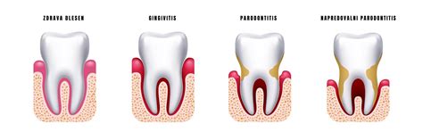 Diagram zobne anatomije z dlesni