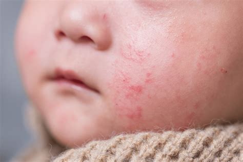 Diagram, ki prikazuje zapletene vzroke dermatitisa pri dojenčkih, vključno z genetskimi, okoljskimi in zunanjimi dejavniki.