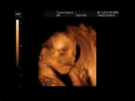 Ultrazvočni posnetek dvojčkov