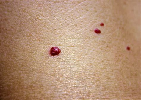 Primer kapilarnega hemangioma na koži