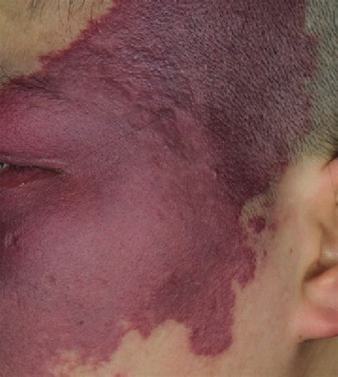 Port wine stain pred lasersko terapijo