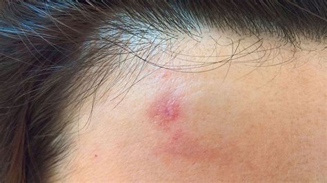 Primer zahtevnejše odstranitve hemangioma na čelu z laserjem