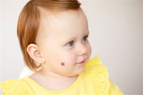 Dojenček z rdečim hemangiomom na licu