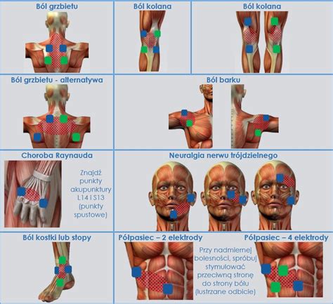 Prikaz namestitve TENS elektrod na ledveno-križno področje
