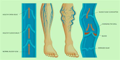 prikaz krčnih žil na nogah