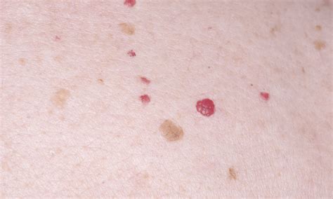 Ilustracija češnjevega angioma na koži