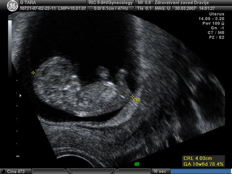 laboratorijske preiskave v nosečnosti