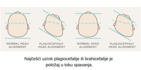 Diagram prikazuje oblike zaležane glave: Plagiocefalija in Brahiocefalija