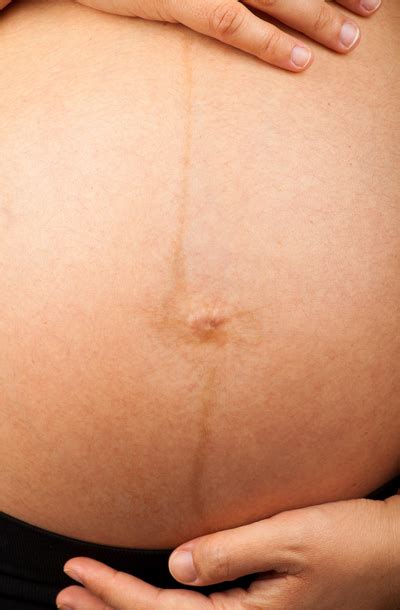 Primer linea nigra in melazme