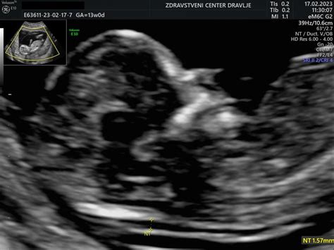 Prikaz merjenja nuhalne svetline na ultrazvočnem posnetku